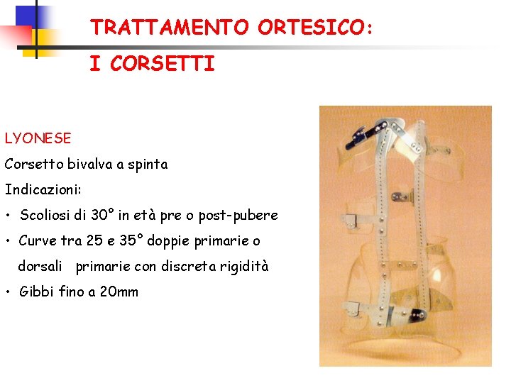 TRATTAMENTO ORTESICO: I CORSETTI LYONESE Corsetto bivalva a spinta Indicazioni: • Scoliosi di 30°