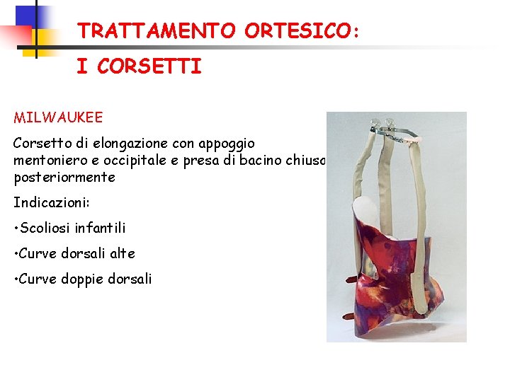 TRATTAMENTO ORTESICO: I CORSETTI MILWAUKEE Corsetto di elongazione con appoggio mentoniero e occipitale e