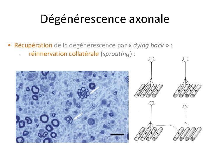 Dégénérescence axonale • Récupération de la dégénérescence par « dying back » : -