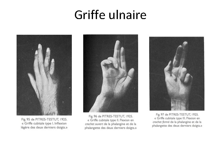 Griffe ulnaire 