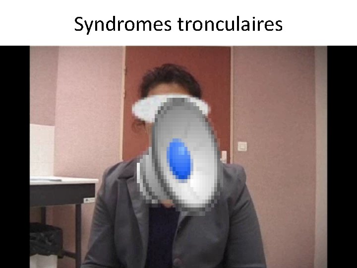 Syndromes tronculaires 