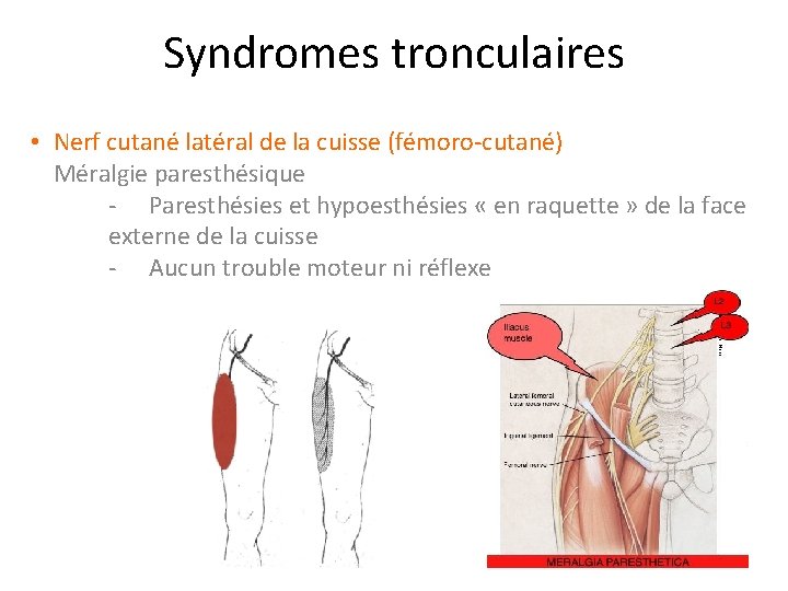 Syndromes tronculaires • Nerf cutané latéral de la cuisse (fémoro-cutané) Méralgie paresthésique - Paresthésies