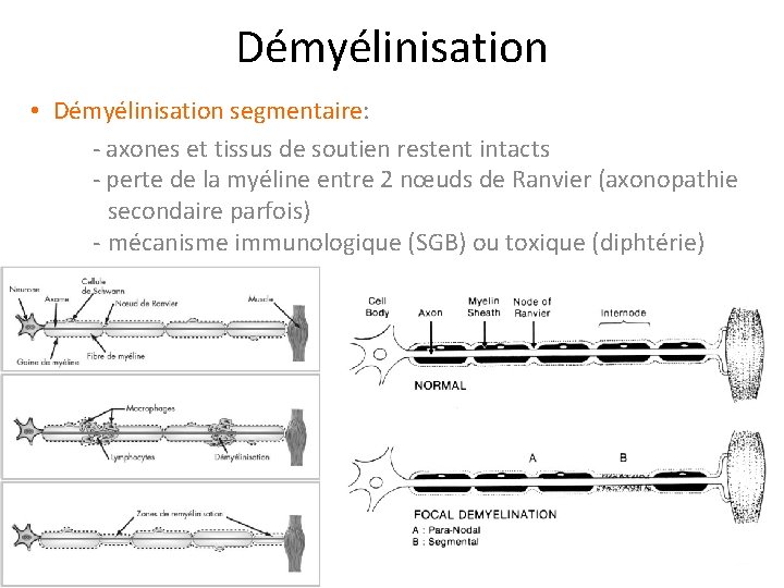 Démyélinisation • Démyélinisation segmentaire: - axones et tissus de soutien restent intacts - perte