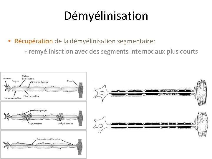 Démyélinisation • Récupération de la démyélinisation segmentaire: - remyélinisation avec des segments internodaux plus