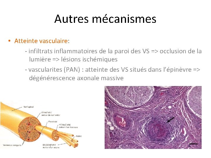 Autres mécanismes • Atteinte vasculaire: - infiltrats inflammatoires de la paroi des VS =>