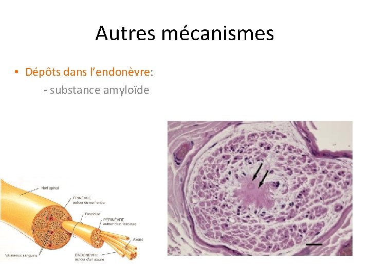 Autres mécanismes • Dépôts dans l’endonèvre: - substance amyloïde 