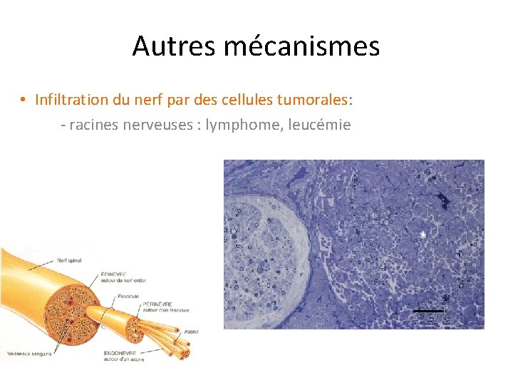 Autres mécanismes • Infiltration du nerf par des cellules tumorales: - racines nerveuses :