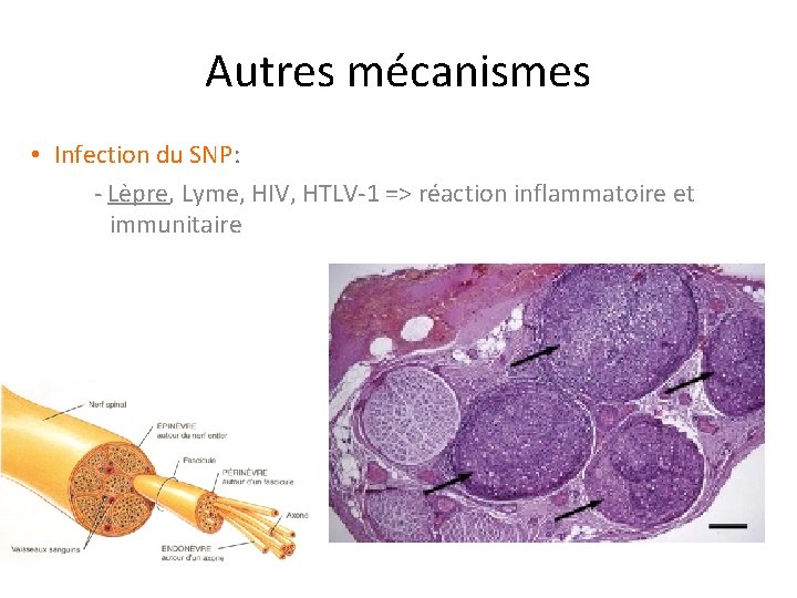 Autres mécanismes • Infection du SNP: - Lèpre, Lyme, HIV, HTLV-1 => réaction inflammatoire