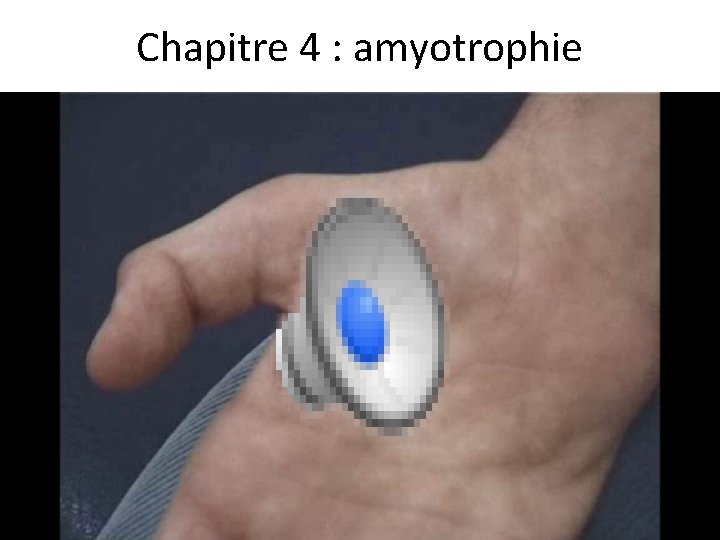 Chapitre 4 : amyotrophie 