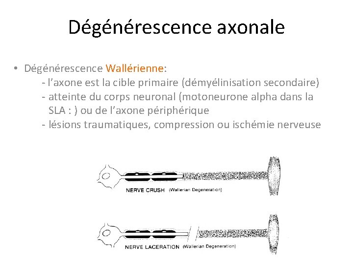 Dégénérescence axonale • Dégénérescence Wallérienne: - l’axone est la cible primaire (démyélinisation secondaire) -