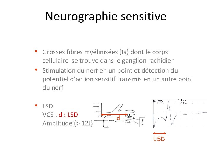 Neurographie sensitive • Grosses fibres myélinisées (Ia) dont le corps • cellulaire se trouve