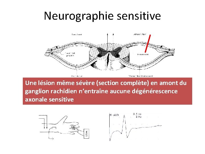 Neurographie sensitive Une lésion même sévère (section complète) en amont du ganglion rachidien n’entraîne