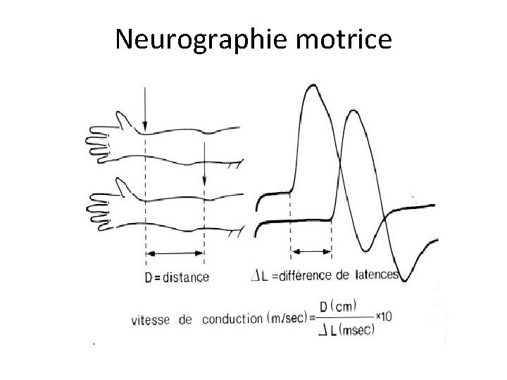 Neurographie motrice 