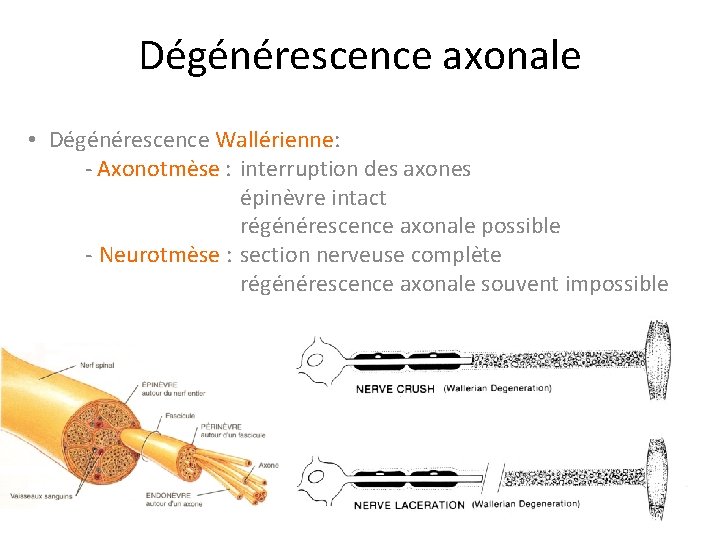 Dégénérescence axonale • Dégénérescence Wallérienne: - Axonotmèse : interruption des axones épinèvre intact régénérescence