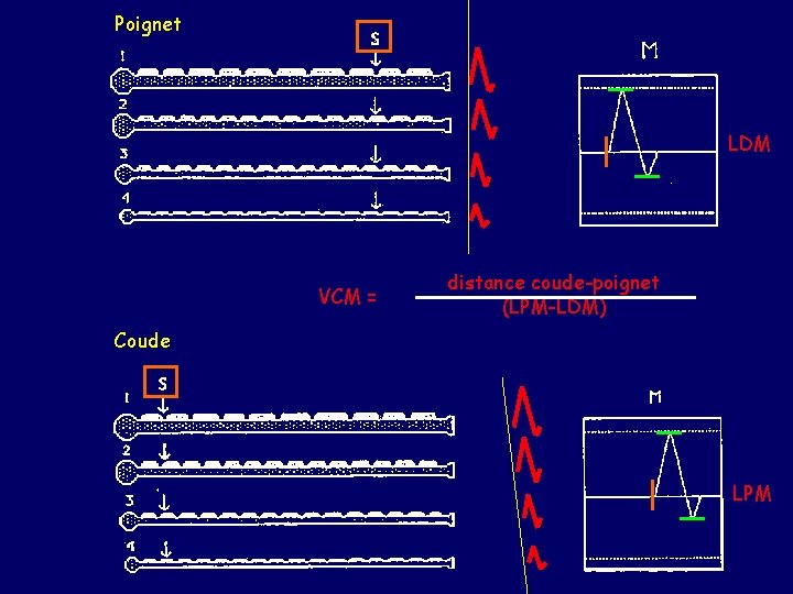 Poignet LDM VCM = distance coude-poignet (LPM-LDM) Coude LPM 
