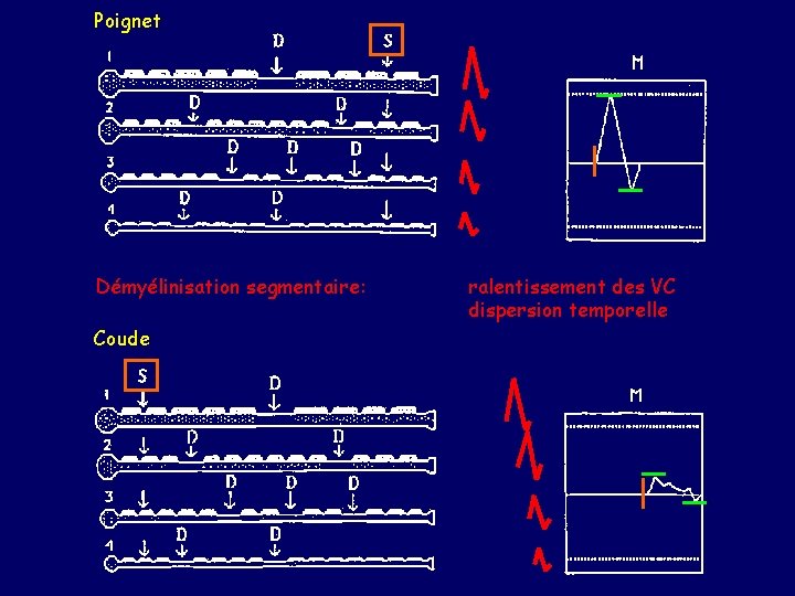 Poignet Démyélinisation segmentaire: Coude ralentissement des VC dispersion temporelle 