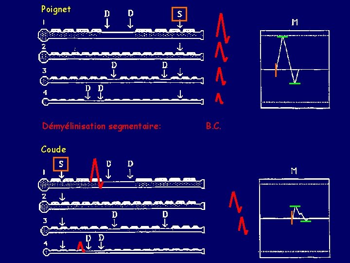 Poignet Démyélinisation segmentaire: Coude B. C. 