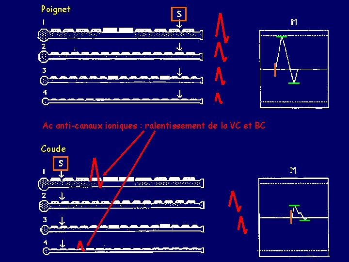 Poignet Ac anti-canaux ioniques : ralentissement de la VC et BC Coude 