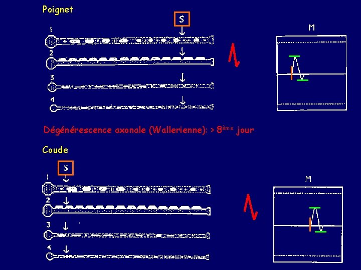 Poignet Dégénérescence axonale (Wallerienne): > 8ème jour Coude 