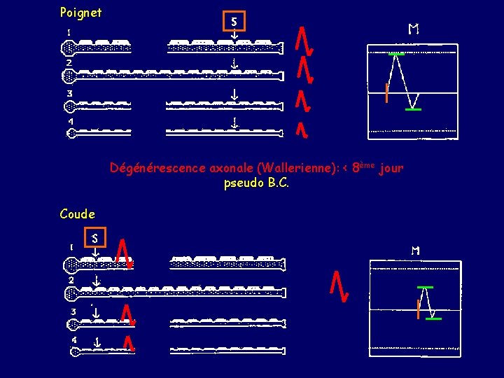 Poignet Dégénérescence axonale (Wallerienne): < 8ème jour pseudo B. C. Coude 