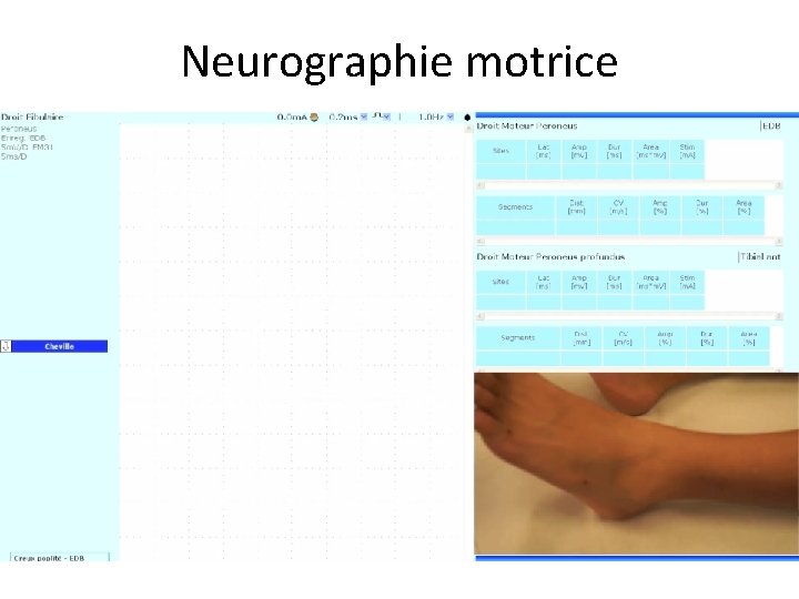 Neurographie motrice 