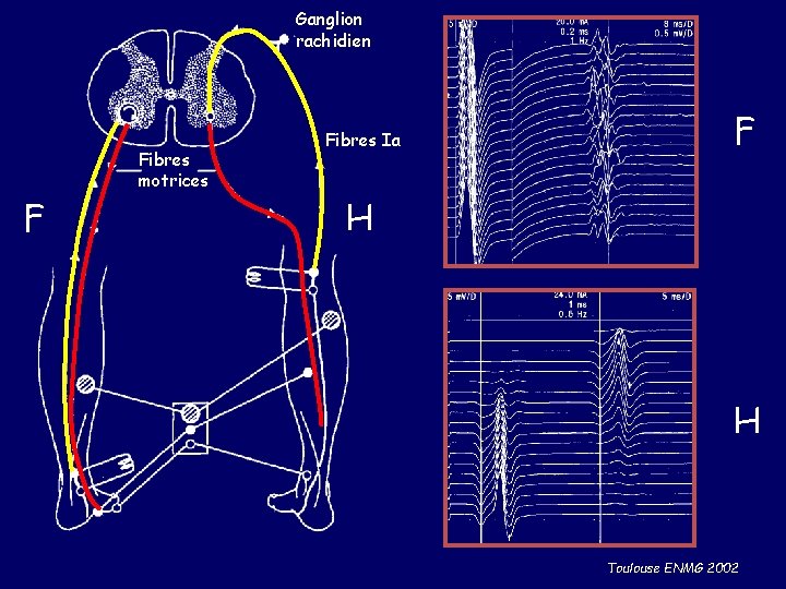 Ganglion rachidien Fibres motrices F Fibres Ia F H H Toulouse ENMG 2002 
