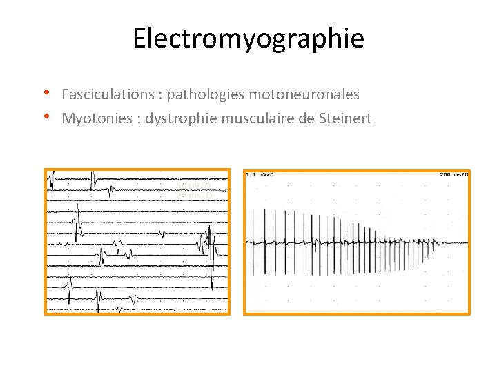 Electromyographie • Fasciculations : pathologies motoneuronales • Myotonies : dystrophie musculaire de Steinert 50