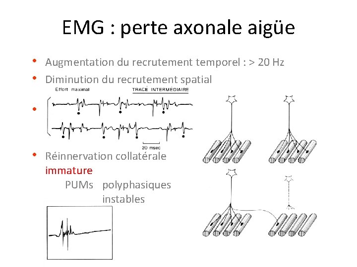 EMG : perte axonale aigüe • Augmentation du recrutement temporel : > 20 Hz