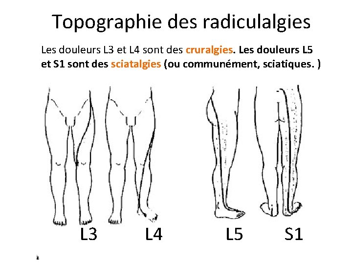 Topographie des radiculalgies Les douleurs L 3 et L 4 sont des cruralgies. Les
