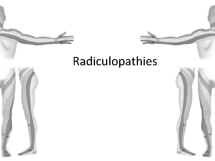 Radiculopathies 