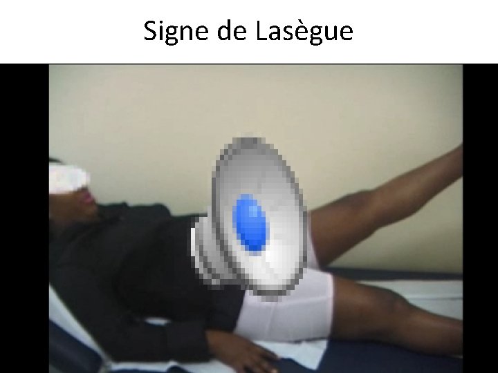 Signe de Lasègue 