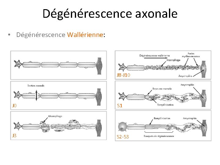 Dégénérescence axonale • Dégénérescence Wallérienne: J 8 -J 10 J 0 S 1 J