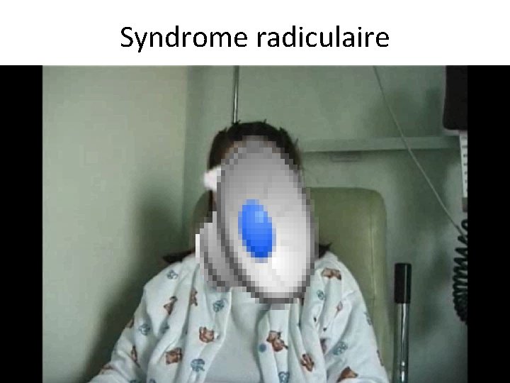 Syndrome radiculaire 