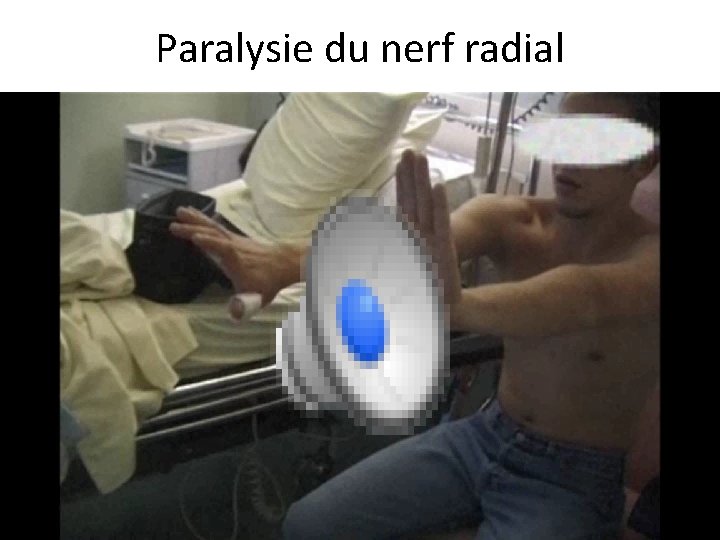 Paralysie du nerf radial 