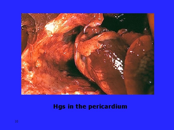 Hgs in the pericardium 10 