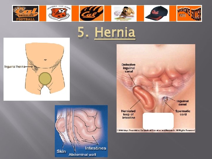 5. Hernia 