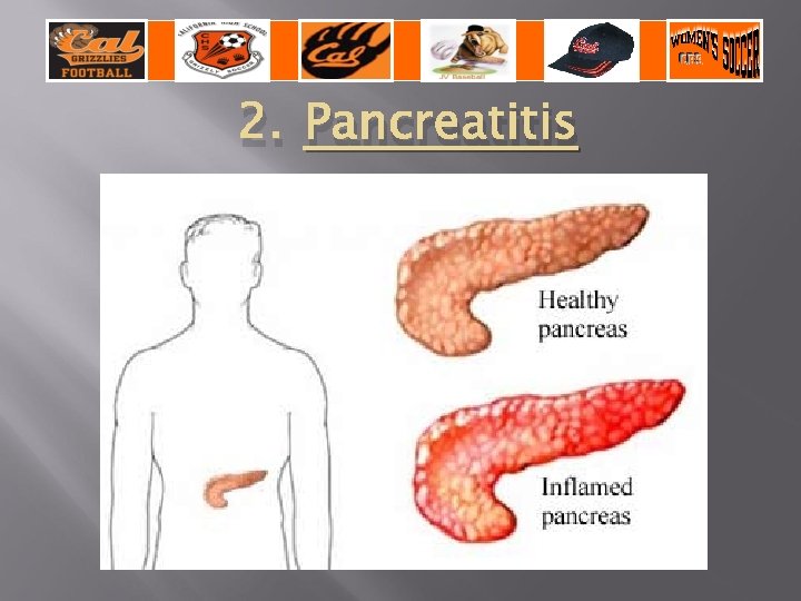 2. Pancreatitis 