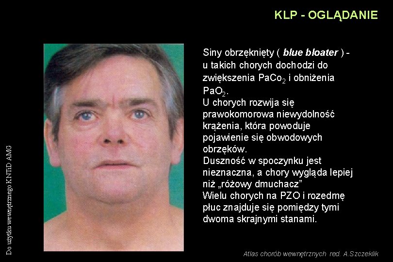 Do użytku wewnętrznego KNTi. D AMG KLP - OGLĄDANIE Siny obrzęknięty ( blue bloater