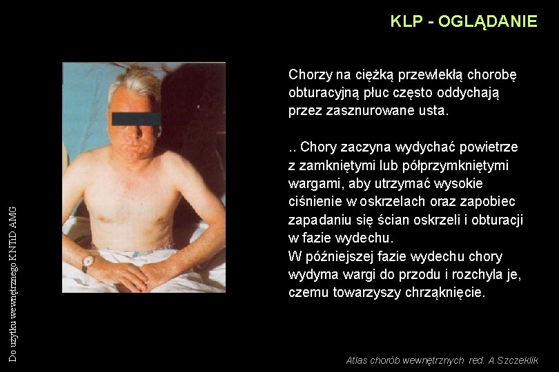 KLP - OGLĄDANIE Do użytku wewnętrznego KNTi. D AMG Chorzy na ciężką przewlekłą chorobę