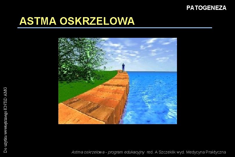 PATOGENEZA Do użytku wewnętrznego KNTi. D AMG ASTMA OSKRZELOWA Astma oskrzelowa - program edukacyjny