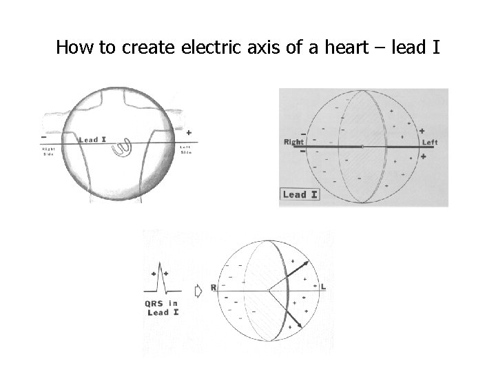 How to create electric axis of a heart – lead I 
