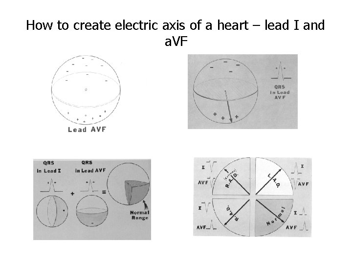 How to create electric axis of a heart – lead I and a. VF