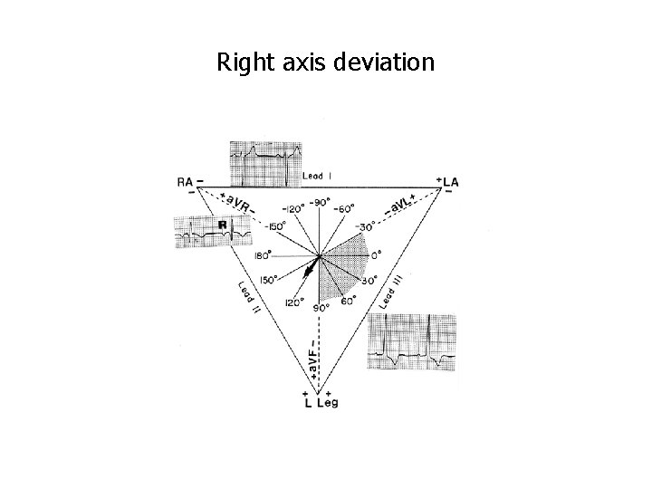 Right axis deviation 