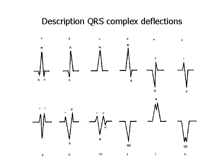 Description QRS complex deflections 