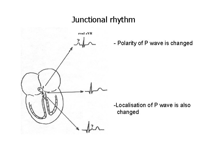 Junctional rhythm - Polarity of P wave is changed -Localisation of P wave is