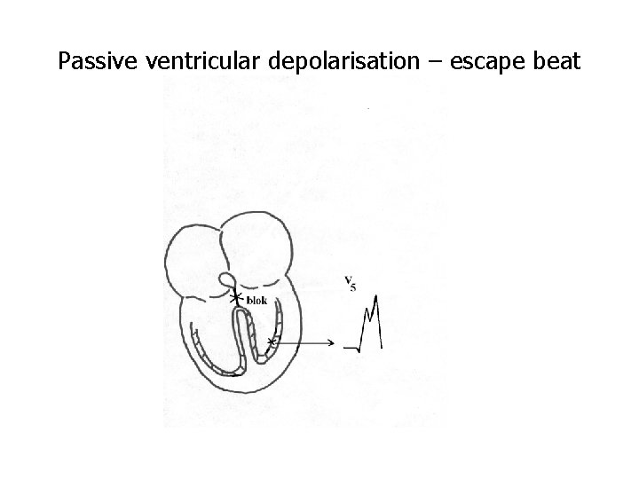 Passive ventricular depolarisation – escape beat 