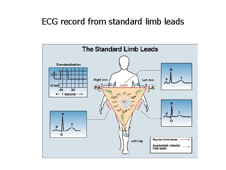 ECG record from standard limb leads 