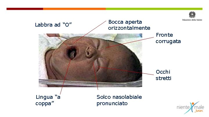 Labbra ad “O” Bocca aperta orizzontalmente Fronte corrugata Occhi stretti Lingua “a coppa” Solco