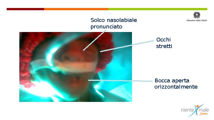 Solco nasolabiale pronunciato Occhi stretti Bocca aperta orizzontalmente 