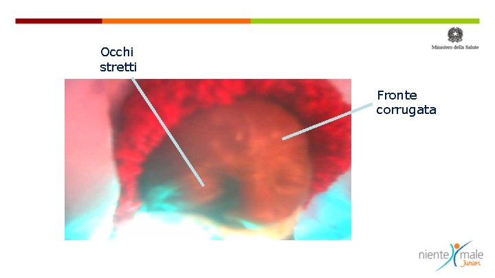 Occhi stretti Fronte corrugata 